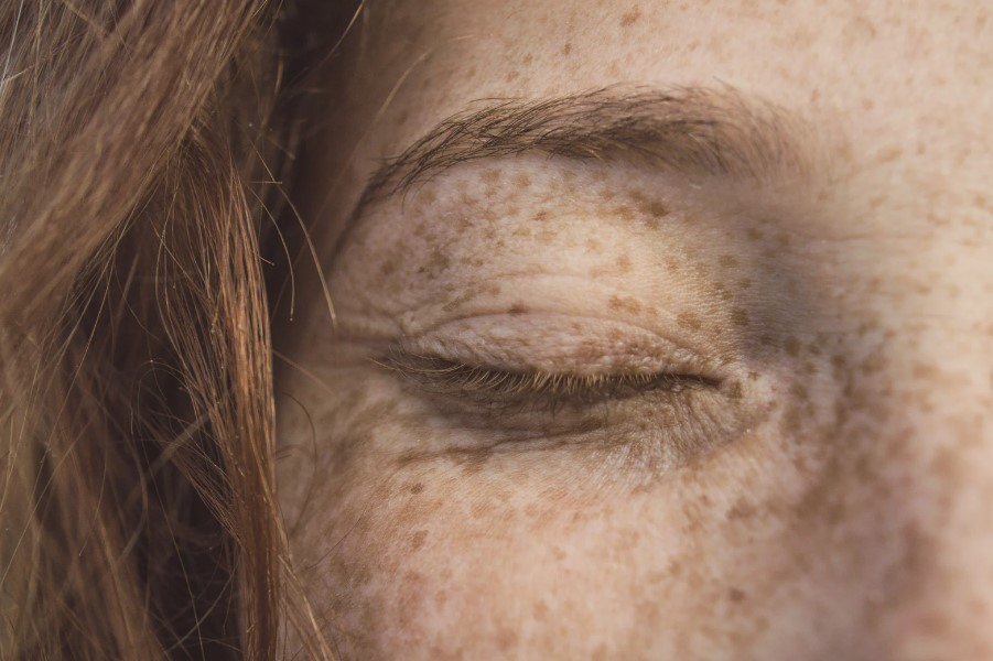 כתמי כולסטרול בעיניים