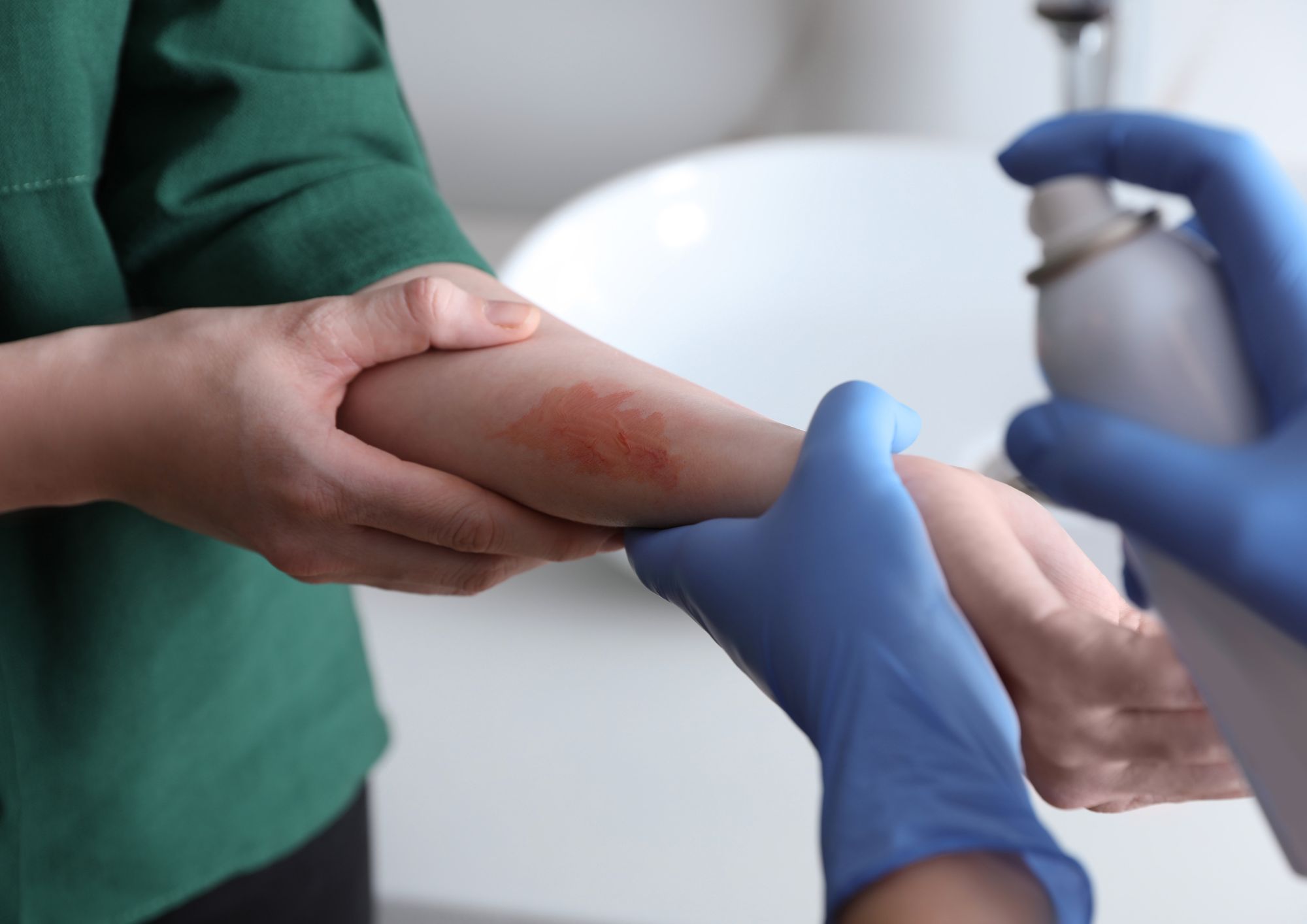 טיפול בכוויות