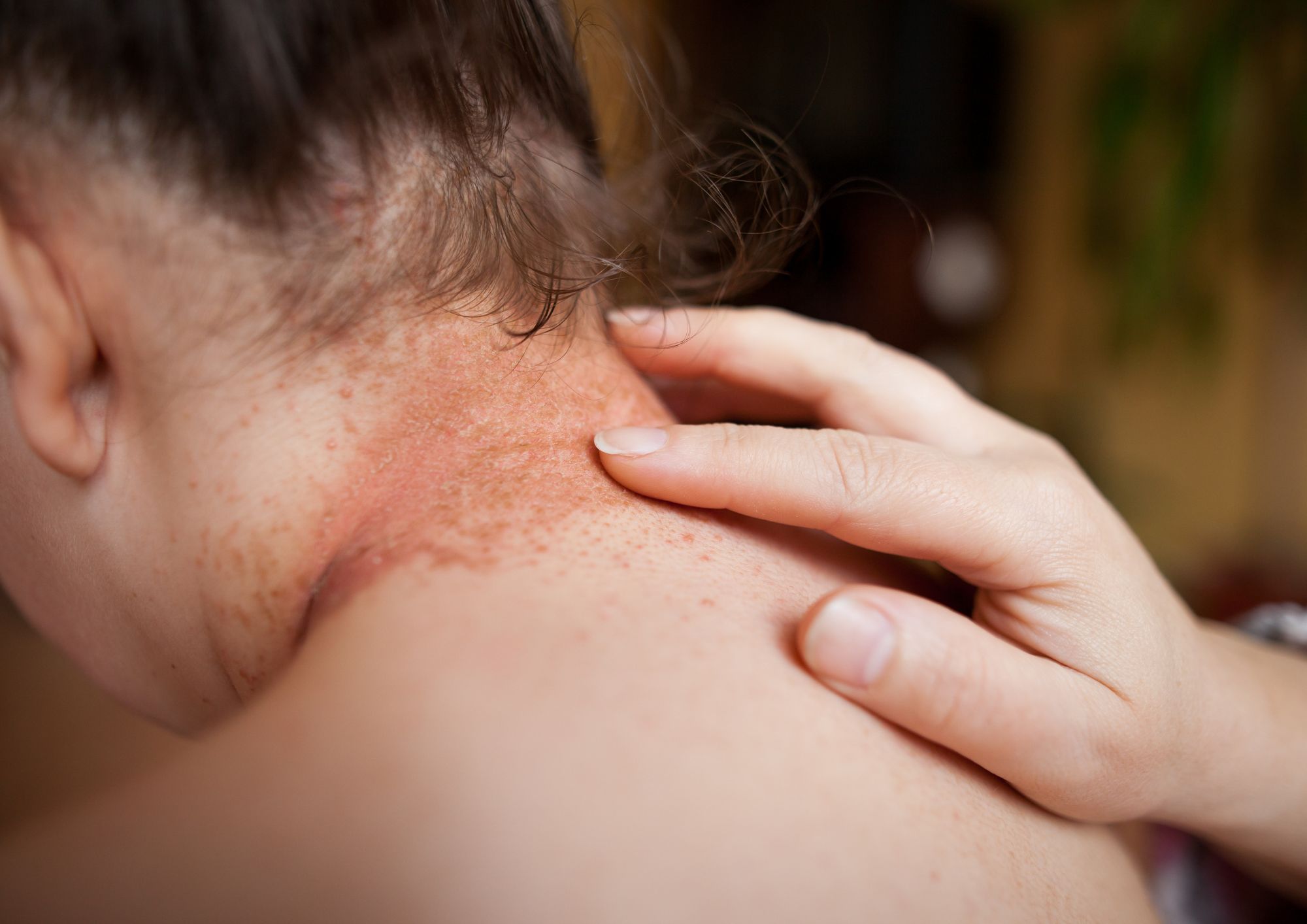 תסמינים של שושנת יריחו