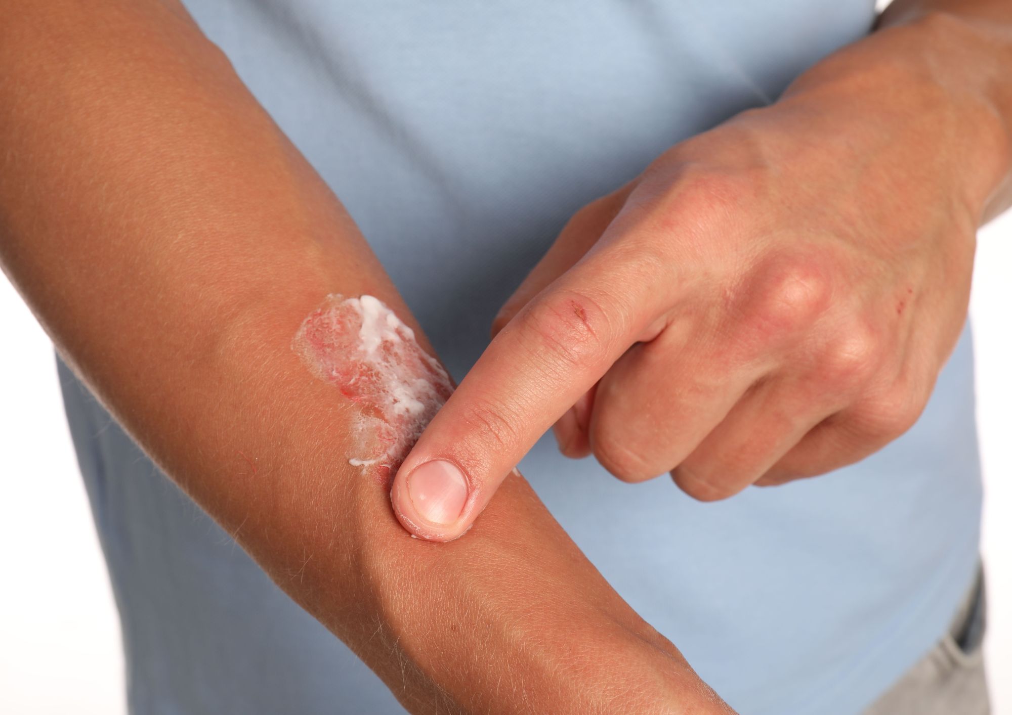 טיפול בכוויות